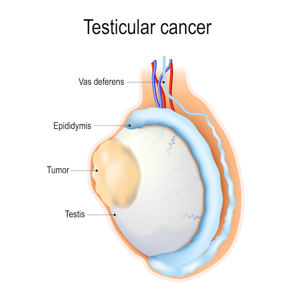 Cancer des Testicules