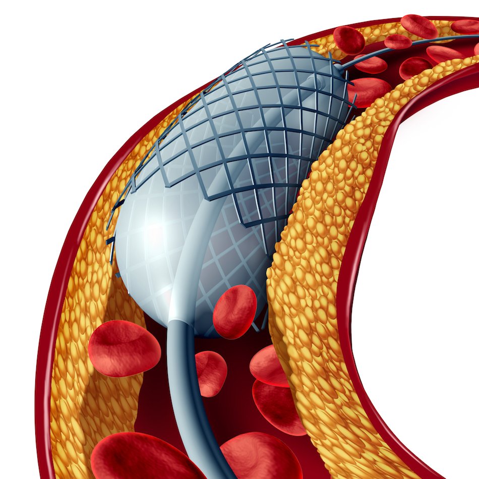 Angioplasty