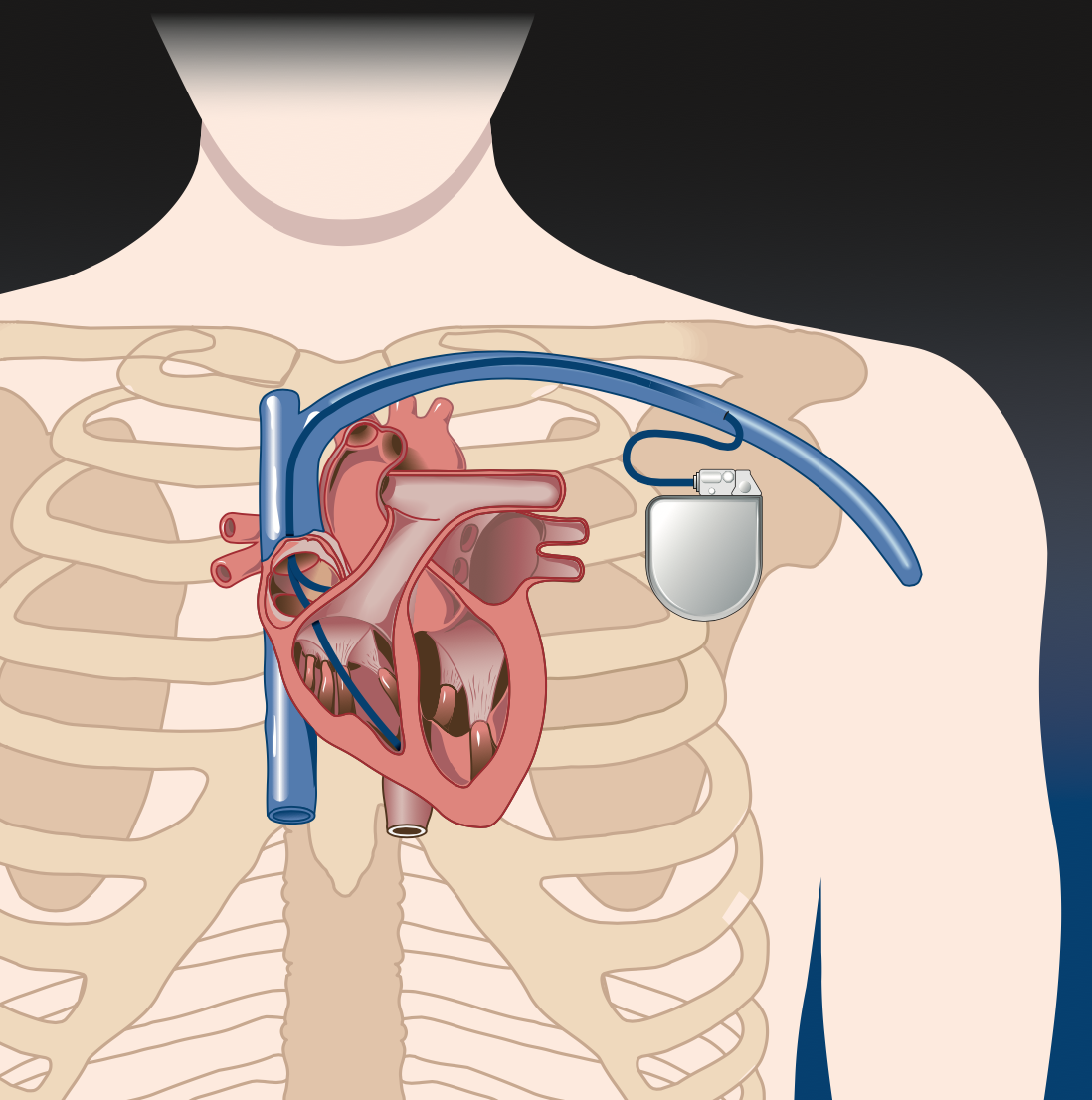 Thérapie de Resynchronisation Cardiaque (CRT)