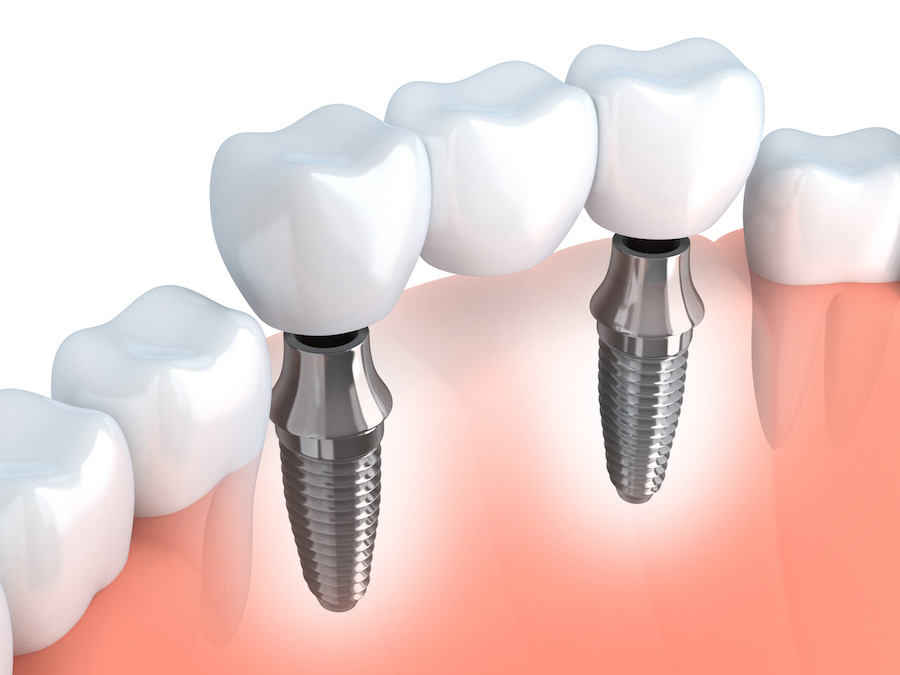 Mini implant et ancrage squelettique