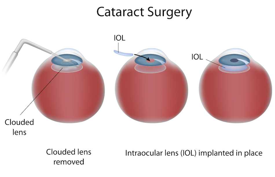 Cataract surgery